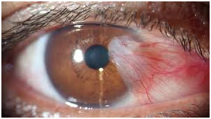 pterygium