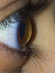 Keratoconus