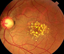 Age Related Macular Degeneration (ARMD)