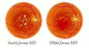 Age Related Macular Degeneration (ARMD)