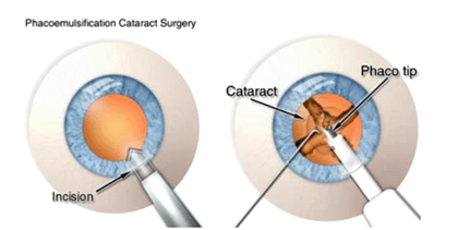 Phacoemulsification Cataract Surgery