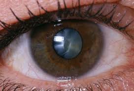 Cataract Surgery