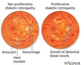 Diabetic Eye Disease