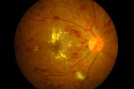 Diabetic Eye Disease