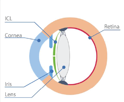 Phakic Intraocular Lenses